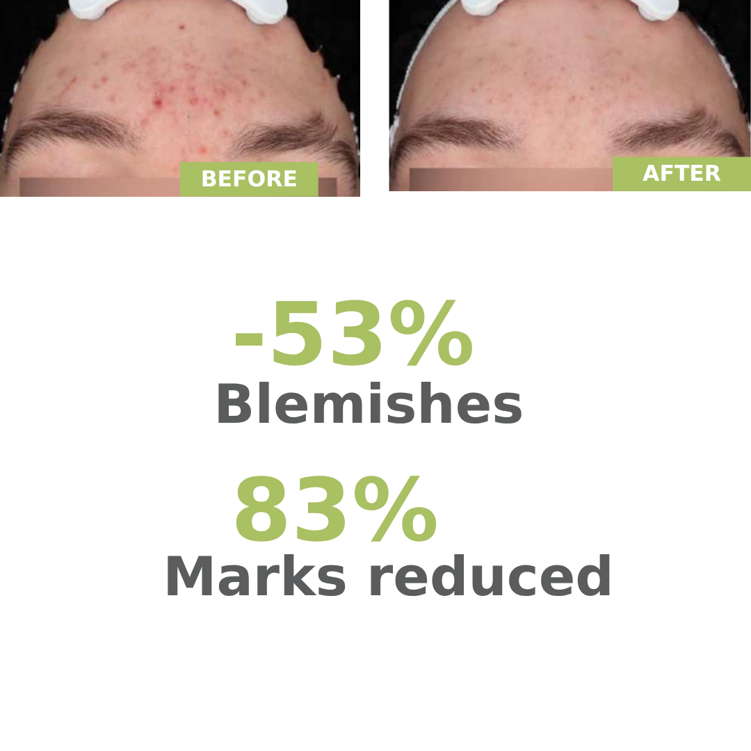A-derma Biology AC Night Peel Anti-Blemish Serum - A-Derma