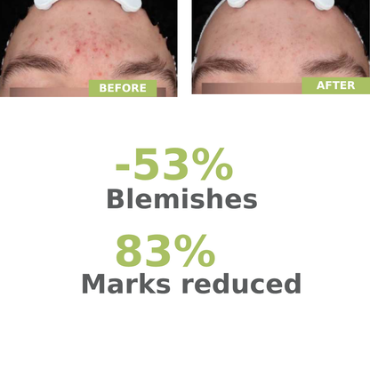 A-derma Biology AC Night Peel Anti-Blemish Serum - A-Derma